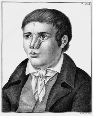 Lot 311, Auction  103, Delpech, Jacques Mathieu, Chirurgie clinique de Montpellier 