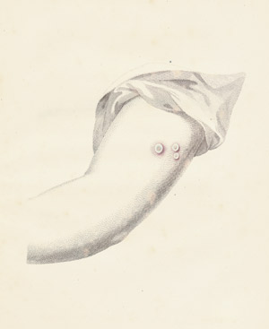 Lot 426, Auction  104, Jenner, Edward, An inquiry into the causes and effects of the variolæ vaccinæ 