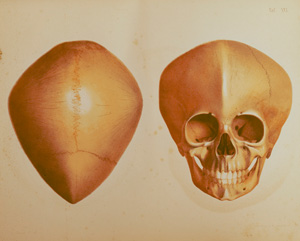 Lot 329, Auction  125, Welcker, Hermann, Untersuchungen über Wachsthum und Bau des menschlichen Schädels. Leipzig, Engelmann, 1862